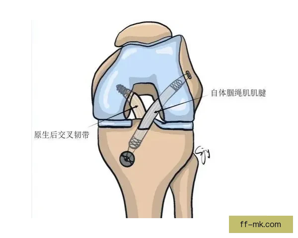 科尔十字韧带断裂后的艰难康复之路全纪录 科尔十字韧带断裂后的艰难康复之路全纪录